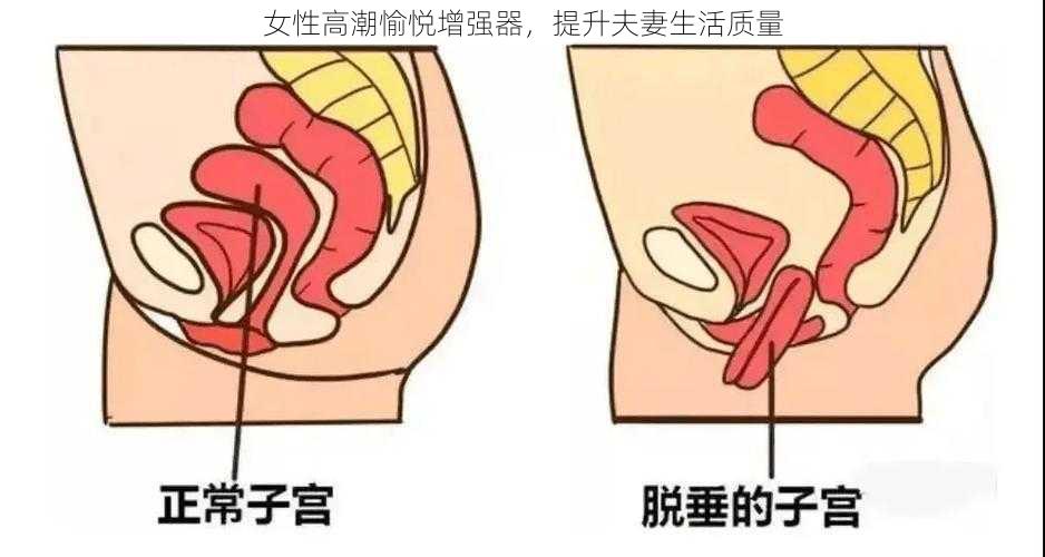 女性高潮愉悦增强器，提升夫妻生活质量